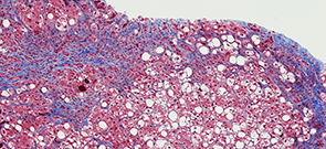Noninvasive NASH Tests
