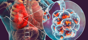 Antibiograms in HABP/VABP