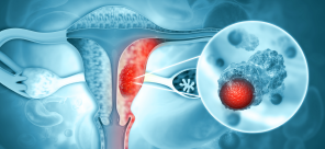 Ovarian Cancer: ESMO Updates