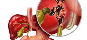 Cholangiocarcinoma Mgmt