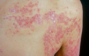Generalized Pustular Psoriasis: Diagnosis and Treatment Options