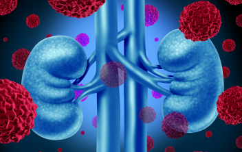 Assessing the Options for Advanced Renal Cell Carcinoma