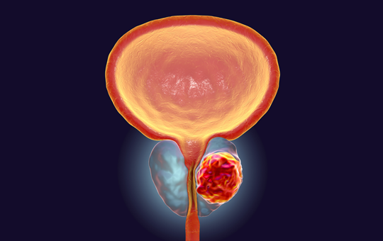 Incorporating PARP Inhibitors for mCRPC: A Nursing Perspective