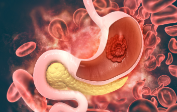 Targeted and Immunotherapies in Advanced Gastric Cancer: Key Data on Treatment Selection and AE Management