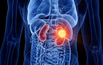 Assessing the Options for Patients With Renal Cell Carcinoma
