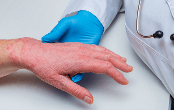 Improving the Co-management of Moderate to Severe Pediatric and Adult Atopic Dermatitis in Primary Care and Specialty Settings