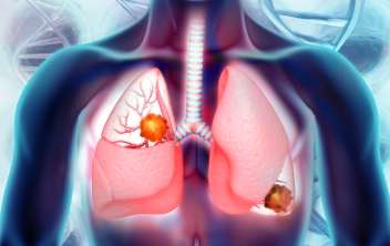 Transforming the Care of Patients With Non-Small-Cell Lung Cancer: Optimizing Immune Checkpoint Inhibitor Therapy