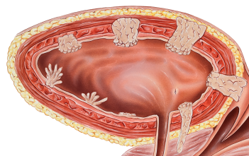 Keeping Up With New Concepts in Managing Advanced Urothelial Cancer
