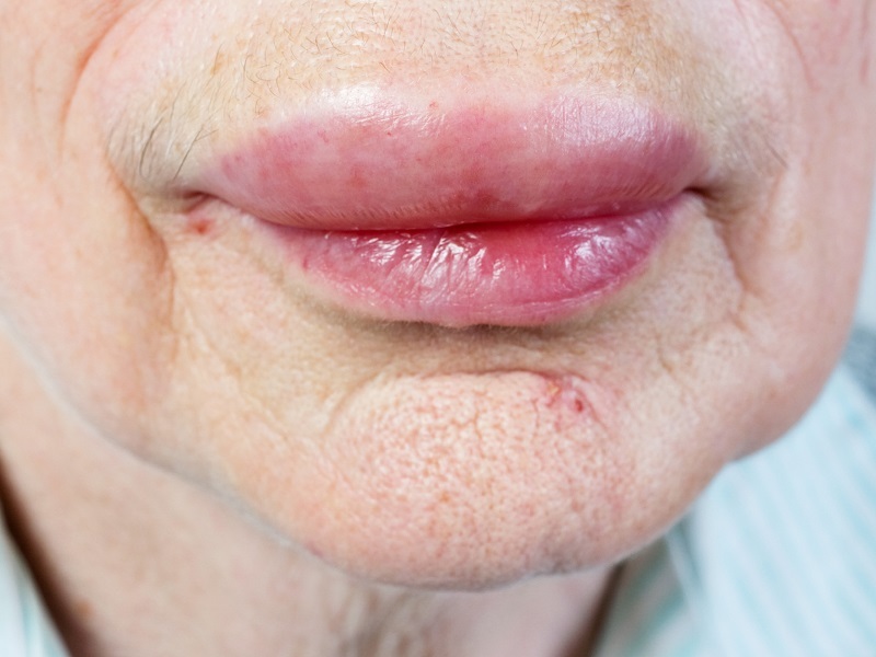 Hereditary Angioedema: Enhancing Patient Quality of Life Through Individualized Treatment and Improved Access to Care