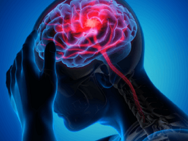 Getting Ahead of the Pain: Preventive Options for Migraine
