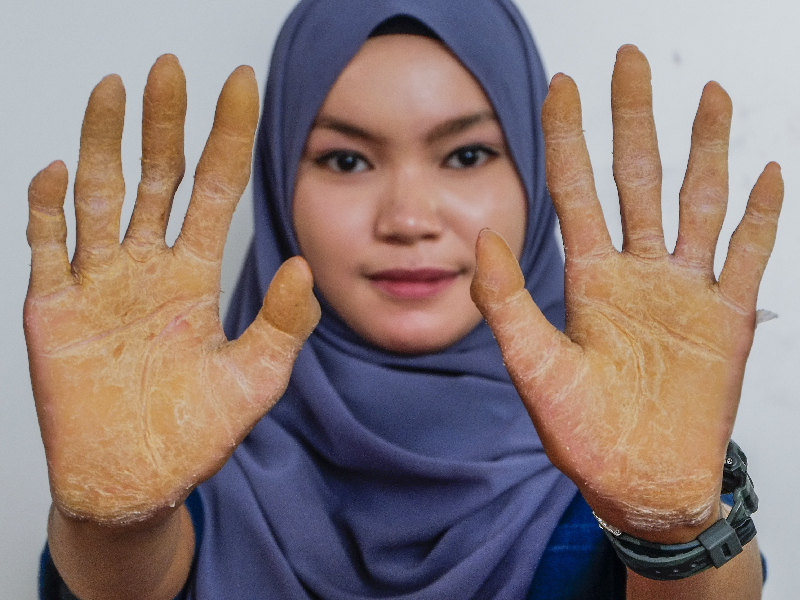 Moderate to Severe Psoriasis