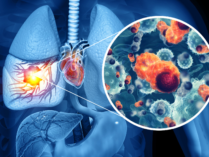 Lung IO: Considerations From Experts