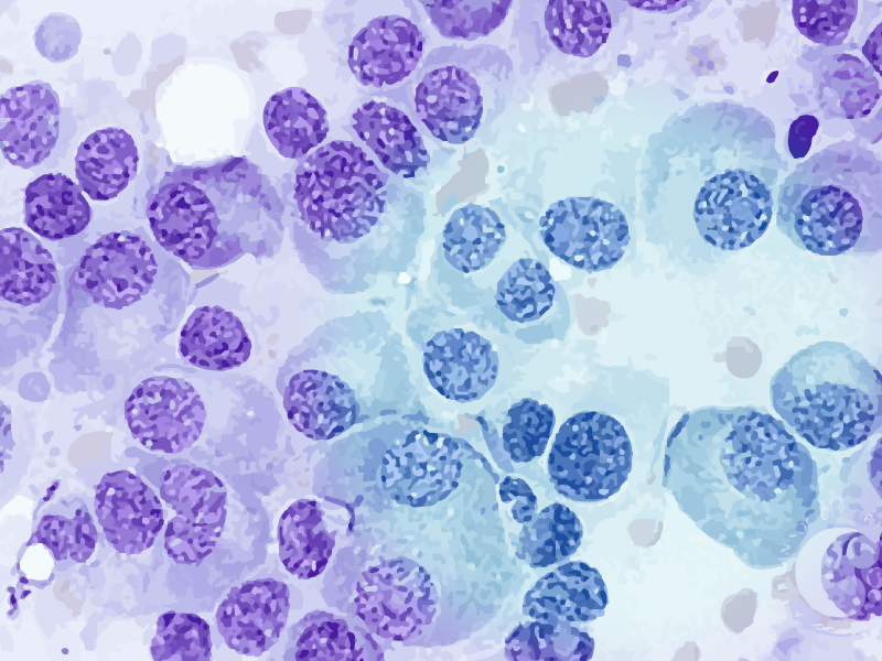 Multiple Myeloma Treatment