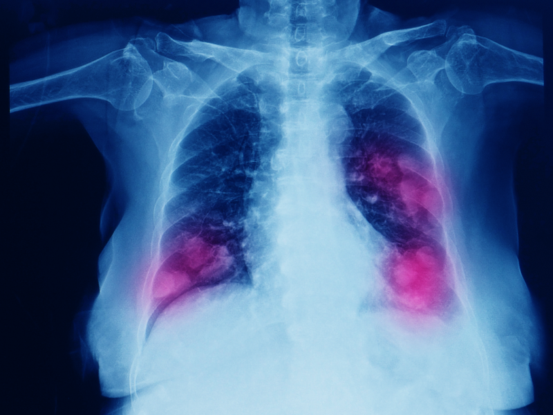 Biomarkers in NSCLC