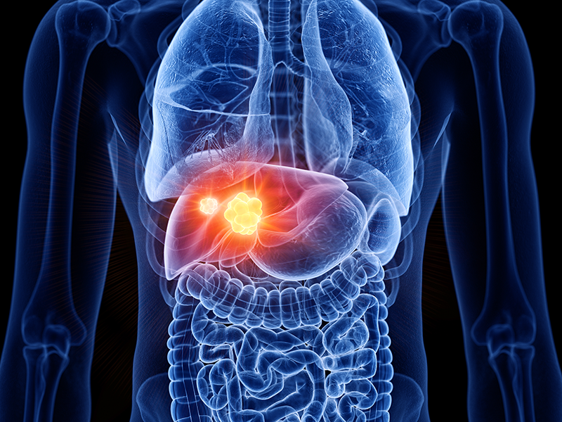 Systemic Therapy for HCC