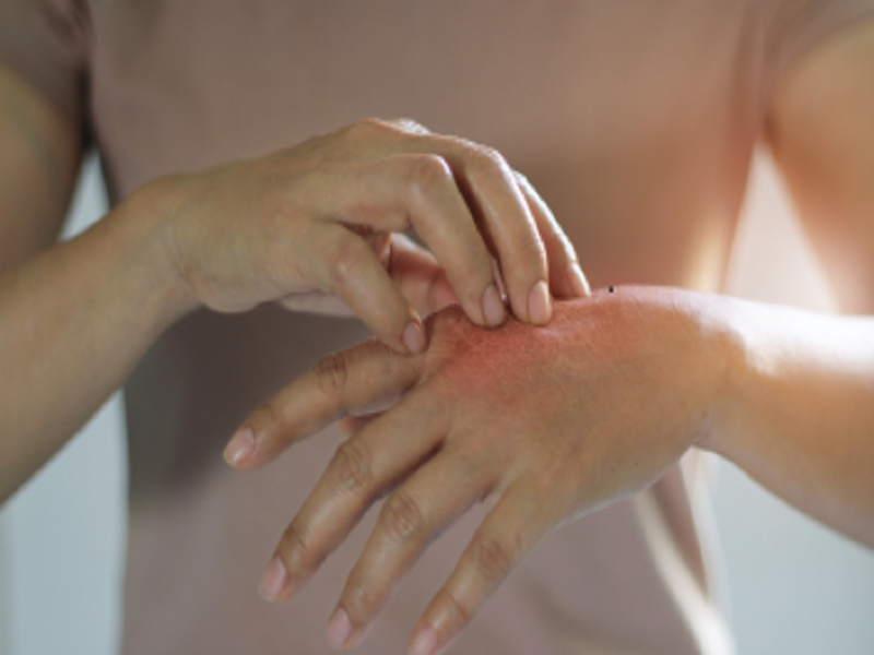 Prurigo Nodularis: A Look at What’s to Come