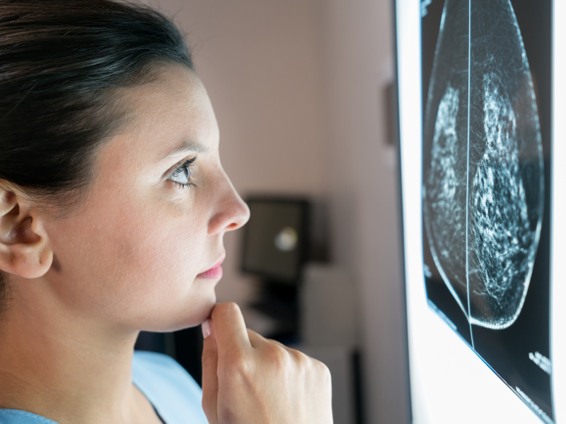 Managing TNBC