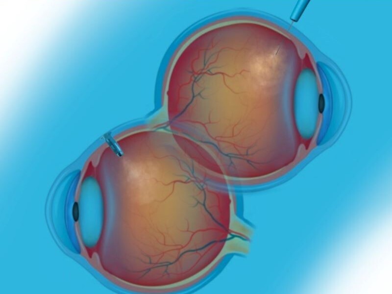 Keeping an Eye on Emerging Anti-VEGF Therapies & Improved Outcomes