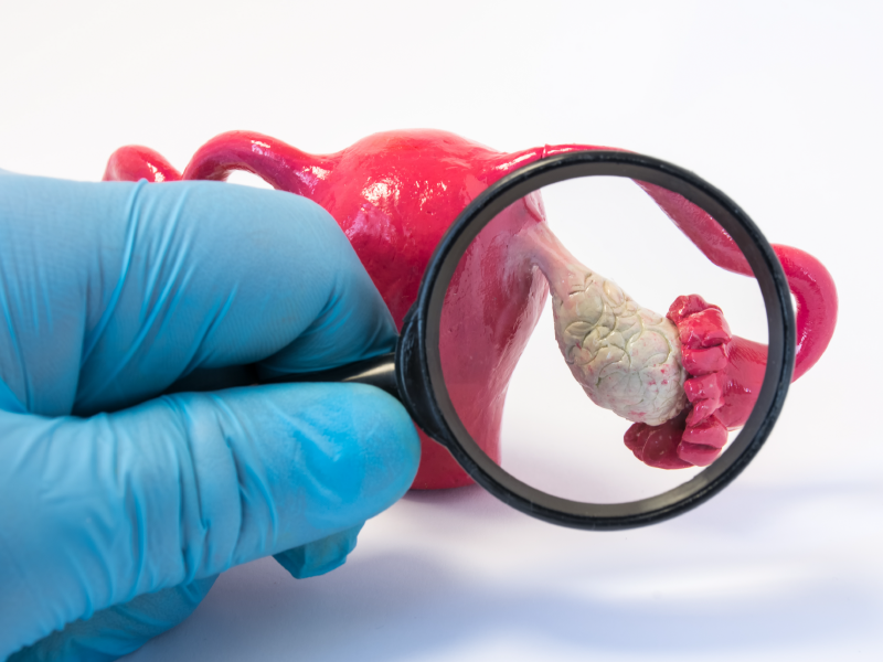 Contemporary Ovarian Cancer
