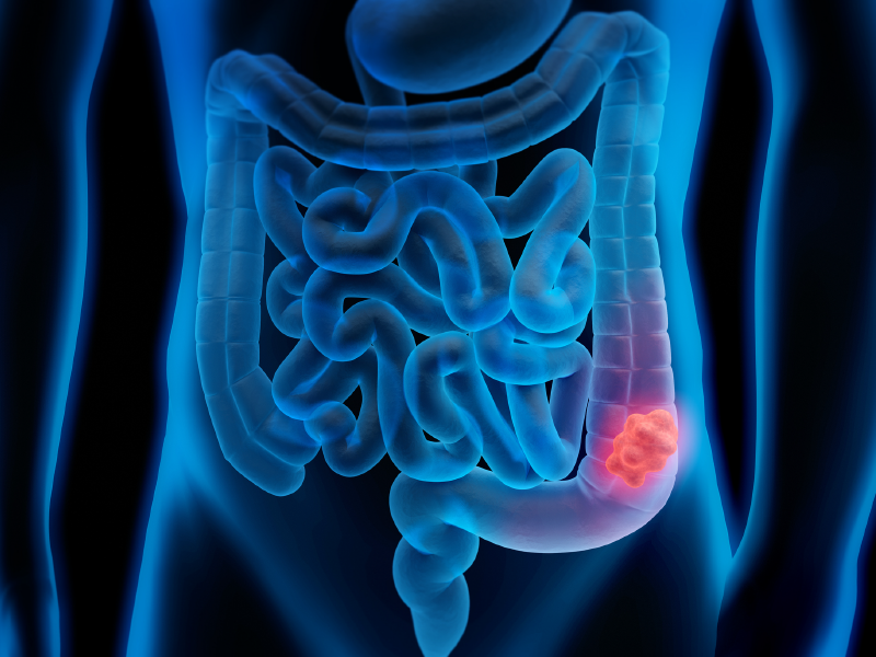 Treating mCRC