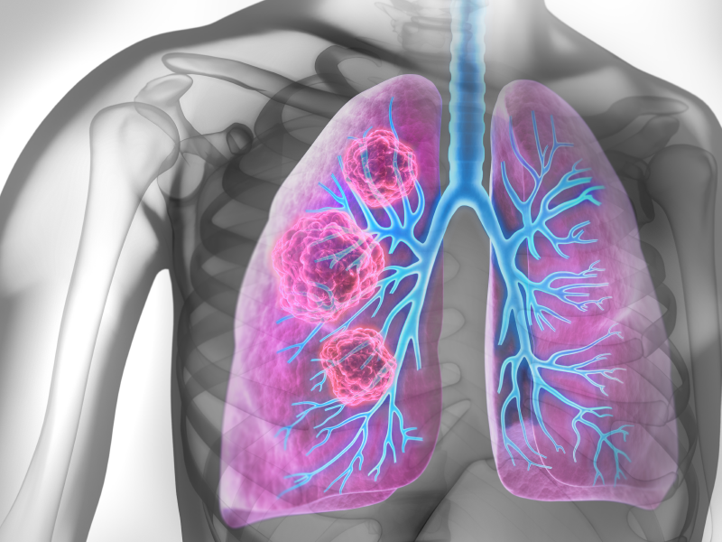 Biomarker Testing in NSCLC