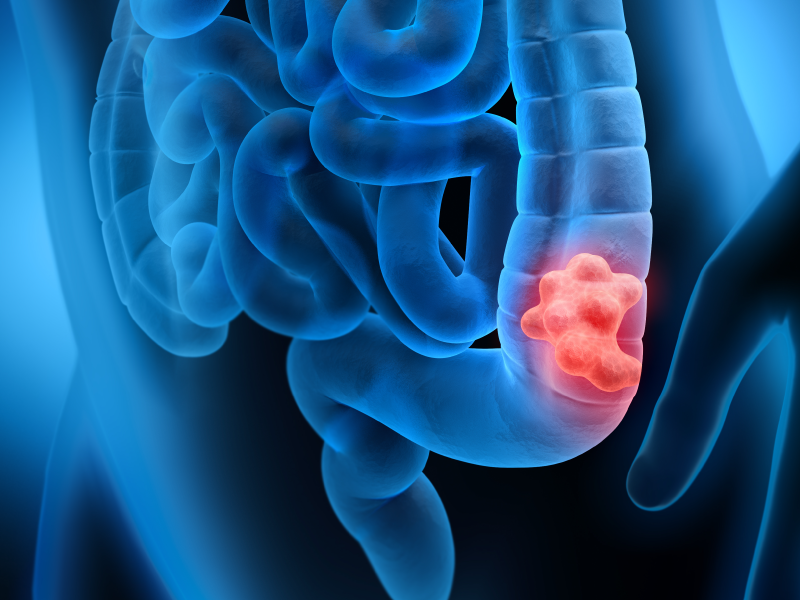 Managing mCRC