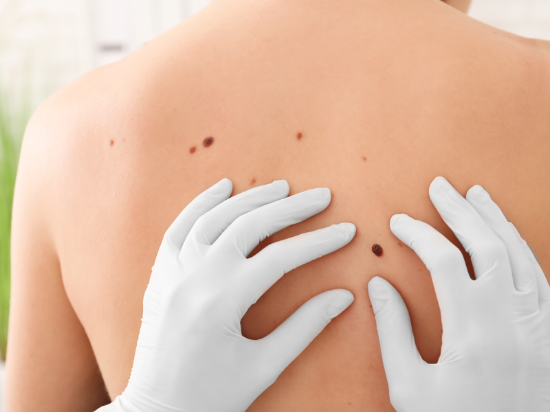 Treatment for Melanoma