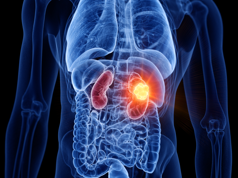 Novel Strategies for RCC