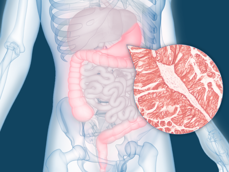FAQs: HER2-Positive GI Cancers