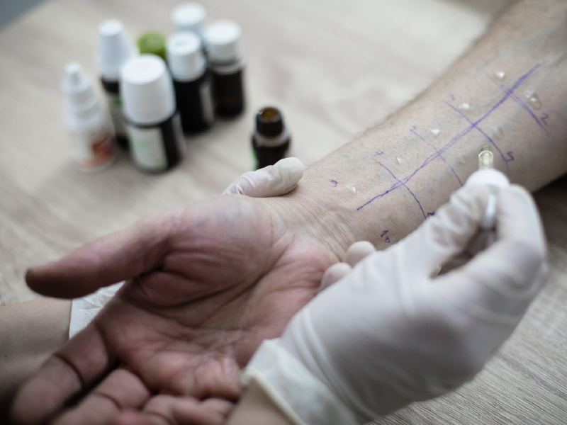 Trigger Avoidance as a Basic Element in Atopic Dermatitis Management