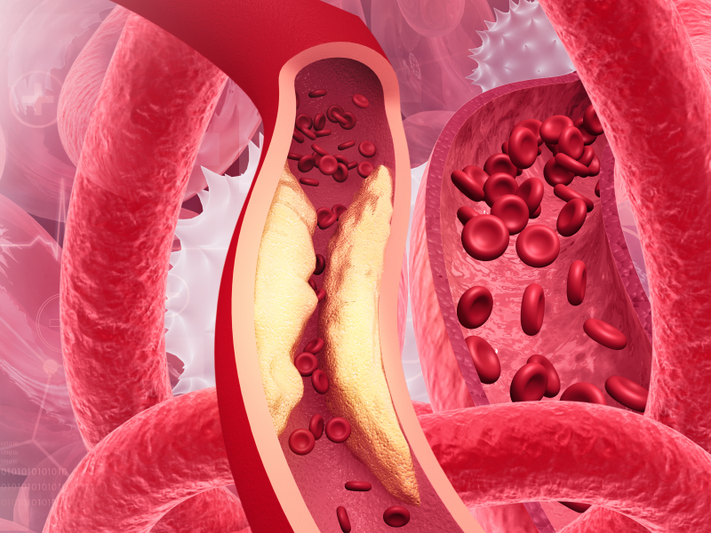 Q&A on Targeting LDL-C