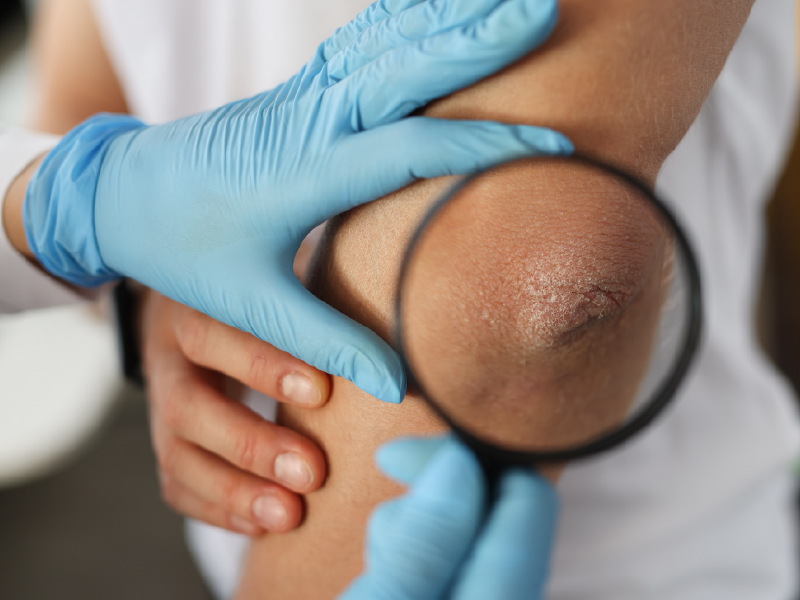 Improving Atopic Dermatitis Care
