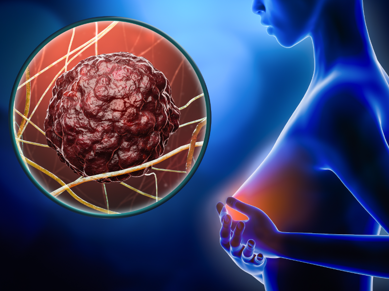 Novel ADCs in Breast Cancer