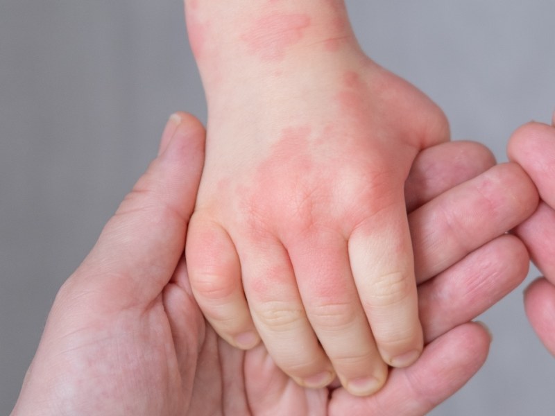 Managing Pediatrics With Atopic Dermatitis