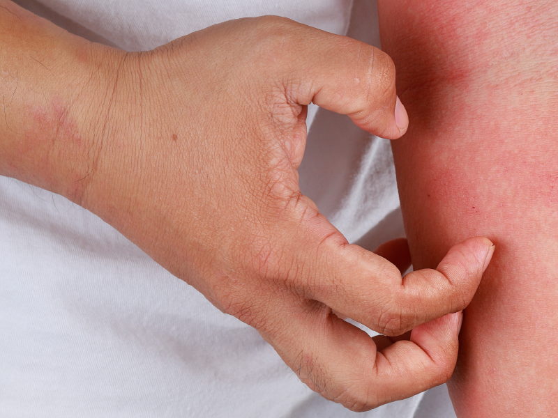 Atopic Dermatitis in Infants and Young Children