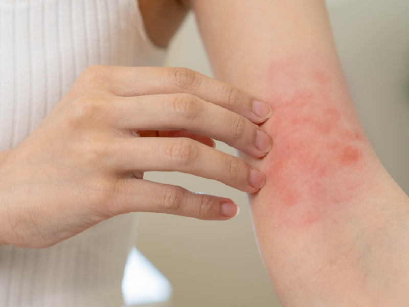 Atopic Dermatitis in Adolescents and Young Adults