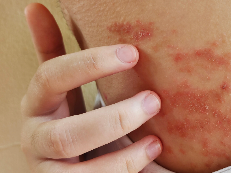Atopic Dermatitis and Prurigo Nodularis Webcast 1