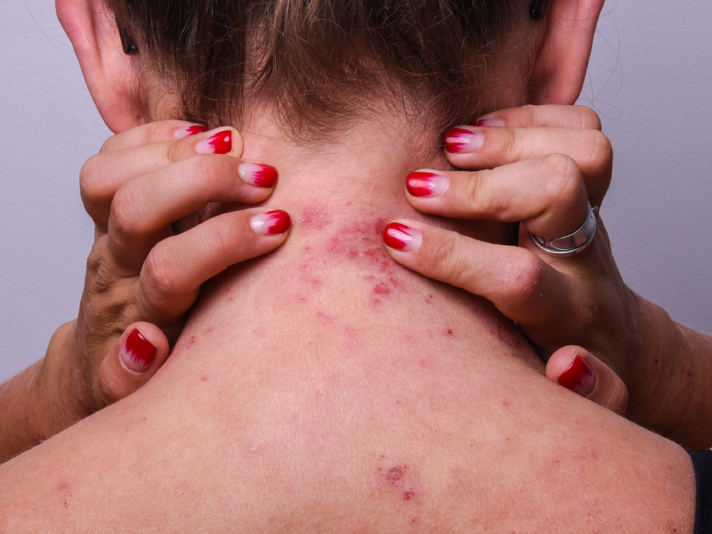 Moderate to Severe Atopic Dermatitis Treatment Selection