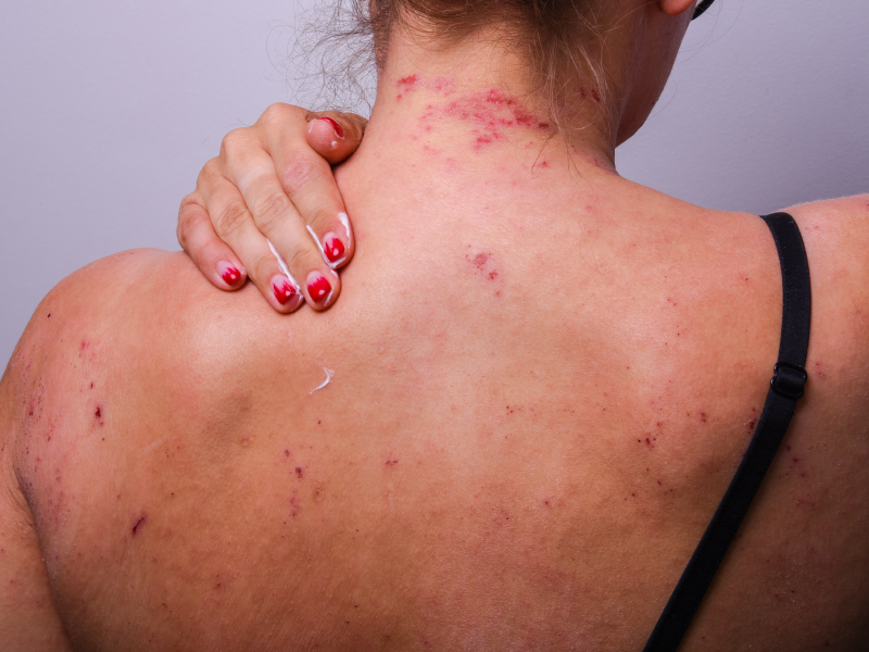 More than skin deep in atopic dermatitis