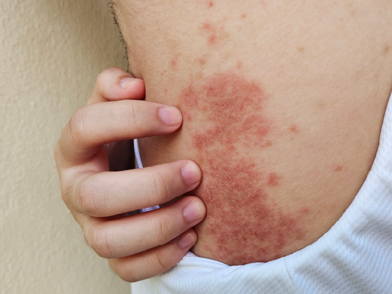 Atopic Dermatitis and Prurigo Nodularis Webcast 2