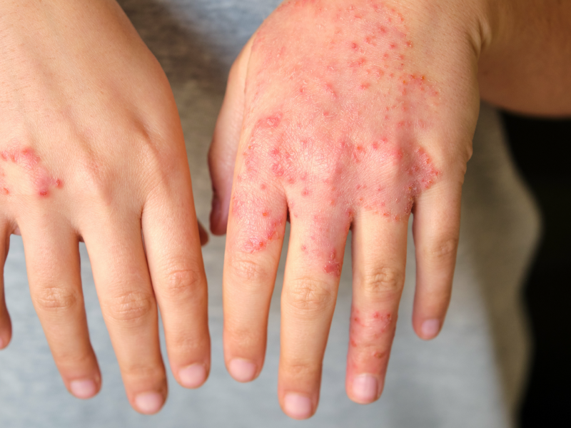 Personalized care for AD diagnosis