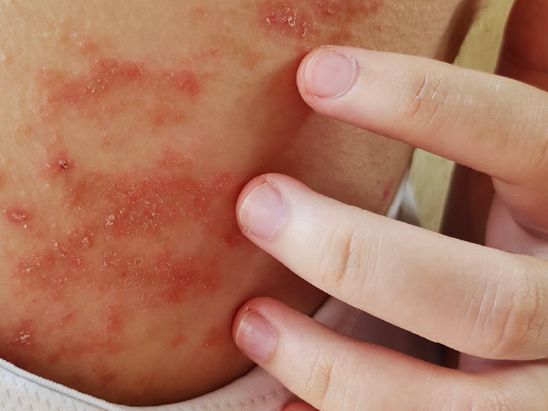 Atopic Dermatitis and Prurigo Nodularis Webcast 3