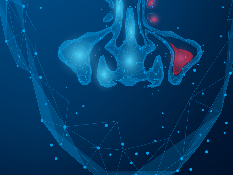 Improving Outcomes in CRSwNP