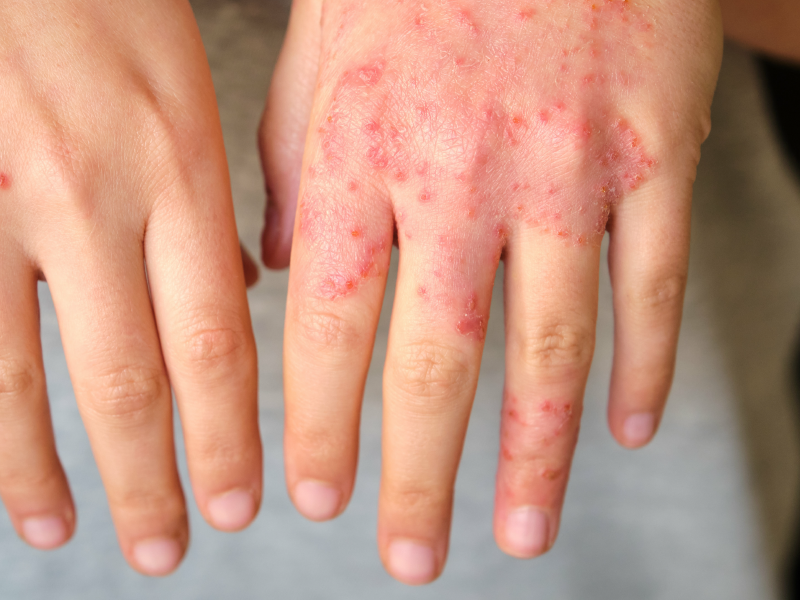 Nonsteroidal topicals for atopic dermatitis