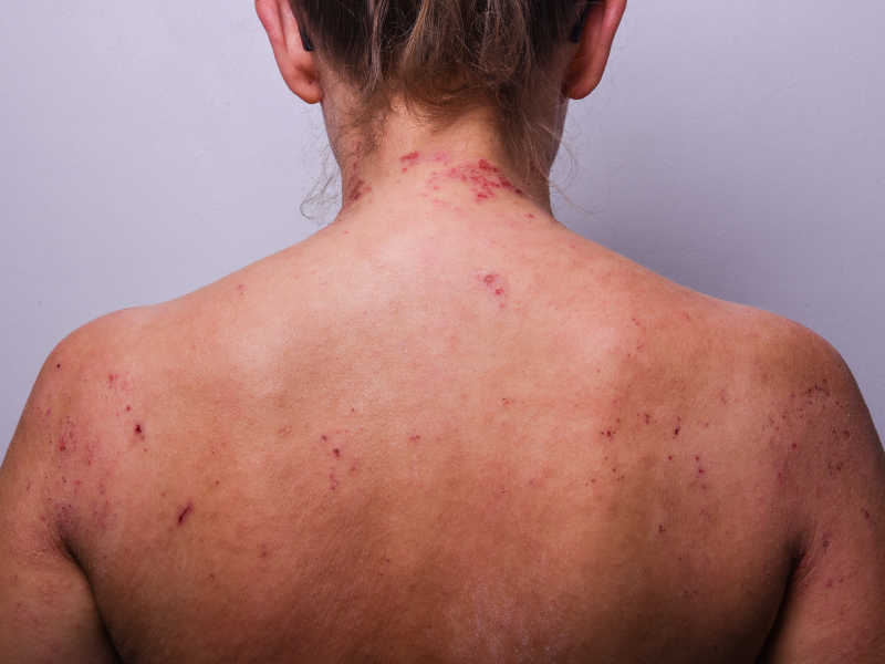 Beyond Basics in Atopic Dermatitis Webcast