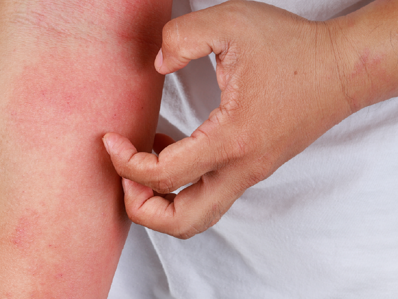 Atopic Dermatitis in Adults
