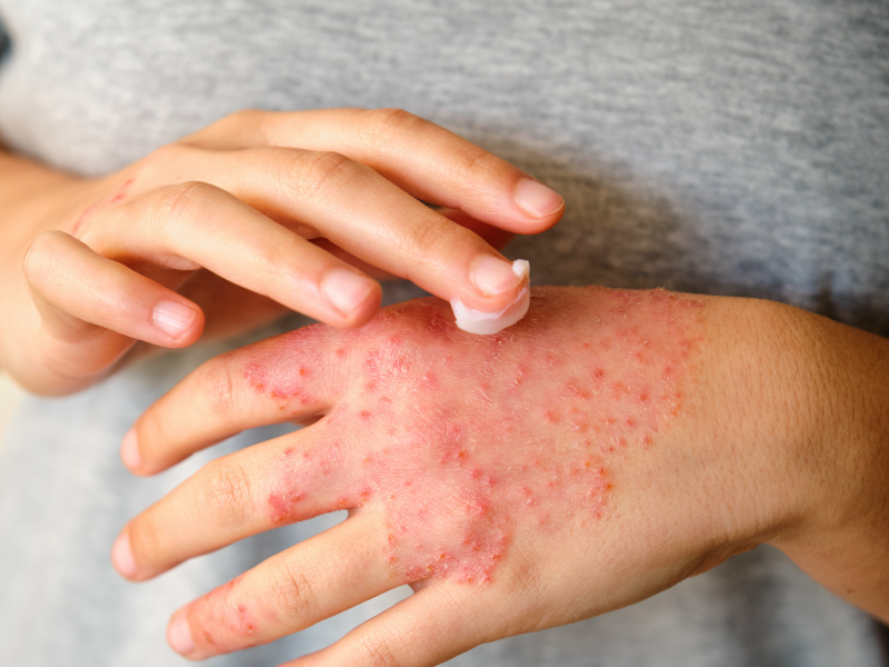 Atopic dermatitis burden and diagnosis pathways