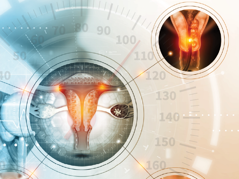 Endometrial Cancer Q&A
