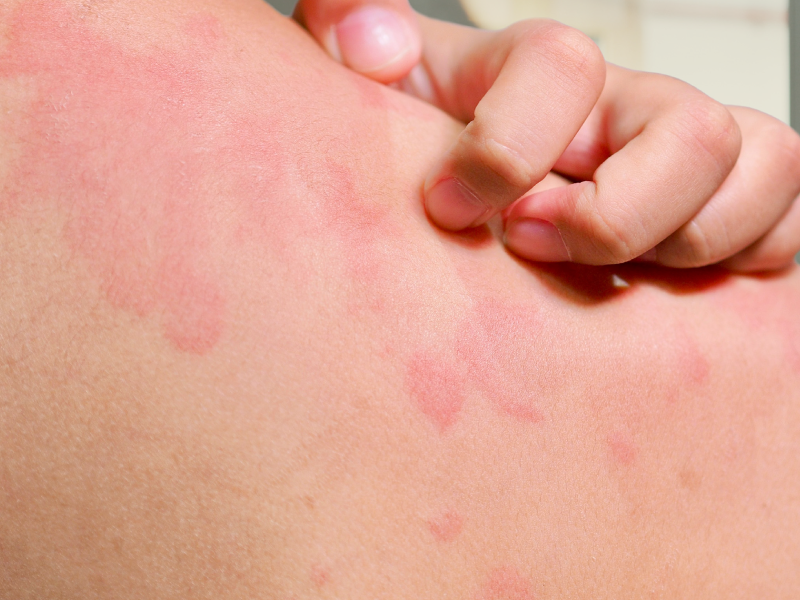 Novel Targeted CSU Therapies