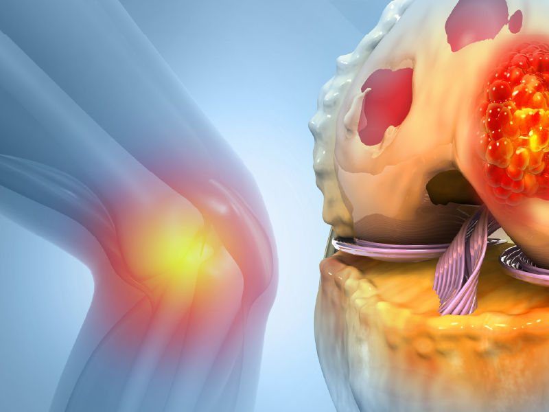 CSF1R Targeted Tx for TGCT
